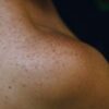 A close up of a woman with freckles on her arm