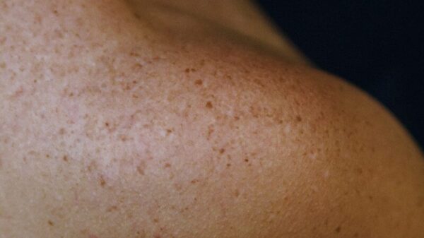 A close up of a woman with freckles on her arm