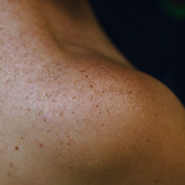 A close up of a woman with freckles on her arm